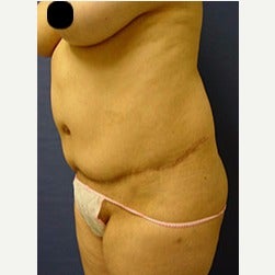 45-54 year old woman treated with Mini Tummy Tuck before 2058543