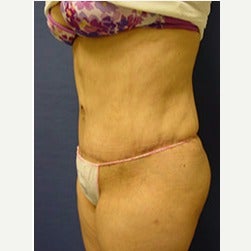 45-54 year old woman treated with Mini Tummy Tuck after 2058543