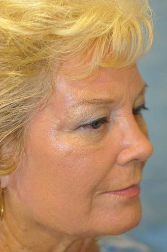 73 Year Old Treated for Aging Face after 1017188