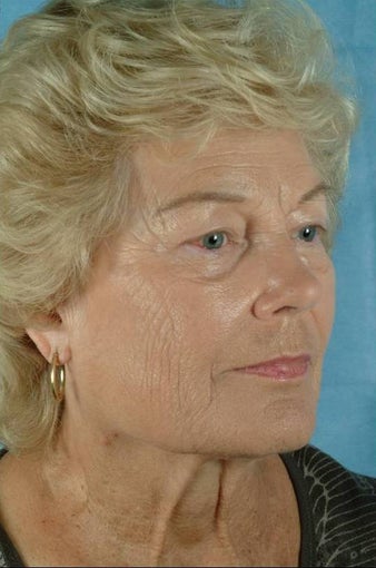 73 Year Old Treated for Aging Face before 1017188
