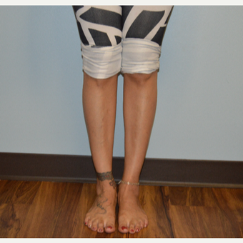 25-34 year old woman treated with Calf Implant after 3629407