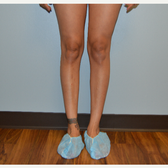 25-34 year old woman treated with Calf Implant before 3629407