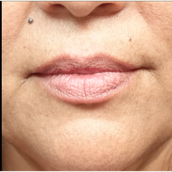 45-54 year old woman treated with Injectable Fillers before 3280171
