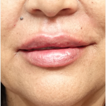 45-54 year old woman treated with Injectable Fillers after 3280171