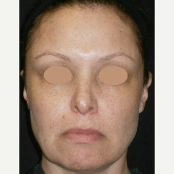 35-44 year old woman treated with IPL after 3146882