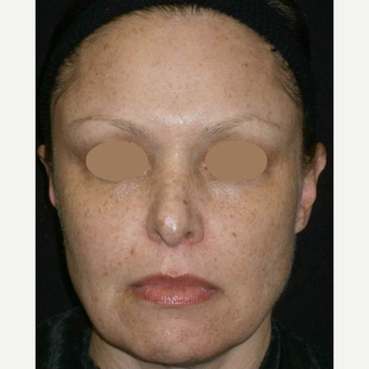 35-44 year old woman treated with IPL before 3146882