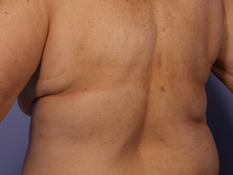CoolSculpting by Zeltiq to Bra Rolls/Back Fat before 375514