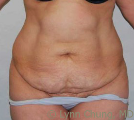 Female in her late 40's-Tummy Tuck before 1277685