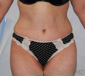 Female in her late 40's-Tummy Tuck after 1277685