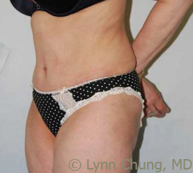 Female in her late 40's-Tummy Tuck 1277685