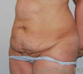 Female in her late 40's-Tummy Tuck 1277685