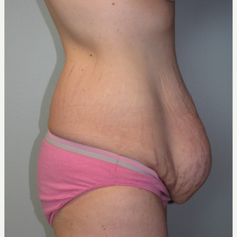 25-34 year old woman treated with Panniculectomy & Hernia Repair before 3141368
