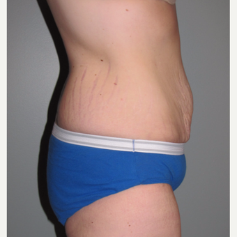 25-34 year old woman treated with Panniculectomy & Hernia Repair after 3141368