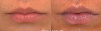 Lip Enhancement With Dermal Fillers before 1447051
