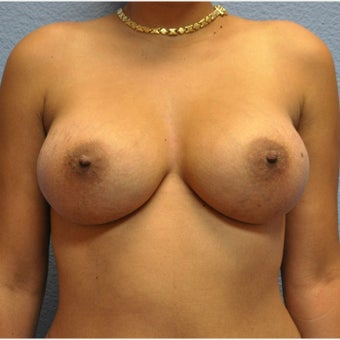 Breast Augmentation, Breast Implants after 1640509