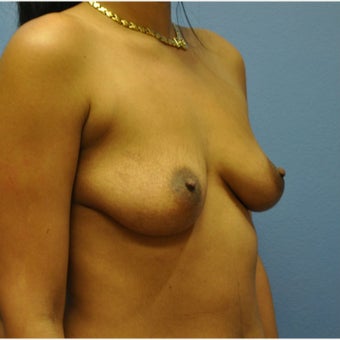 Breast Augmentation, Breast Implants 1640509