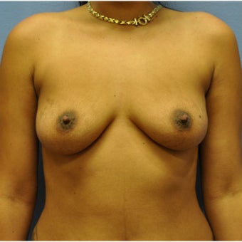 Breast Augmentation, Breast Implants before 1640509