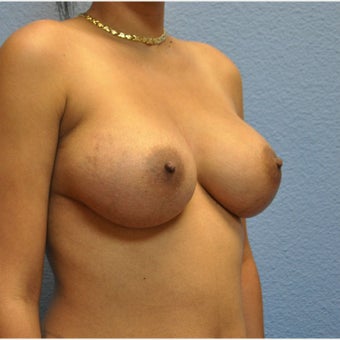 Breast Augmentation, Breast Implants 1640509