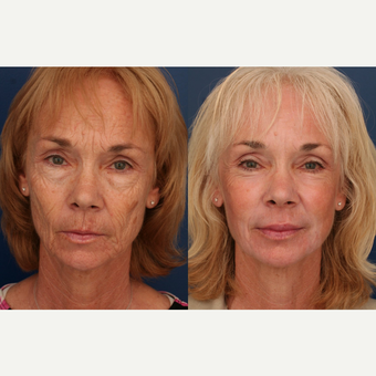 45-54 year old woman treated with Fat Transfer before 3705977