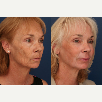 45-54 year old woman treated with Fat Transfer after 3705977
