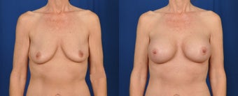 45-54 year old woman treated with Breast Augmentation before 3226361
