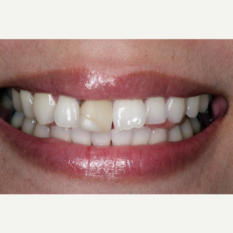 25-34 year old woman treated with Dental Implants before 3629687