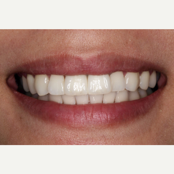 25-34 year old woman treated with Dental Implants after 3629687