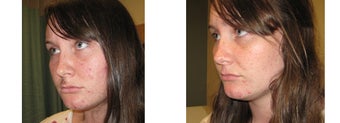Mole Removal photos before 951884