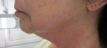 Forma Radio-frequency Treatment Series for Neck after 1795979