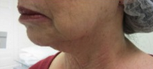 Forma Radio-frequency Treatment Series for Neck before 1795979