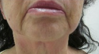 Forma Radio-frequency Treatment Series for Neck 1795979