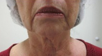 Forma Radio-frequency Treatment Series for Neck 1795979