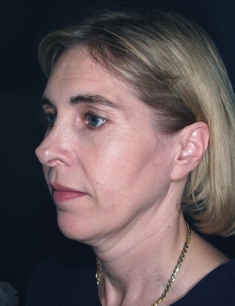 Laser used for cutting - Vertical Facelift before 113264