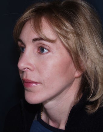 Laser used for cutting - Vertical Facelift after 113264