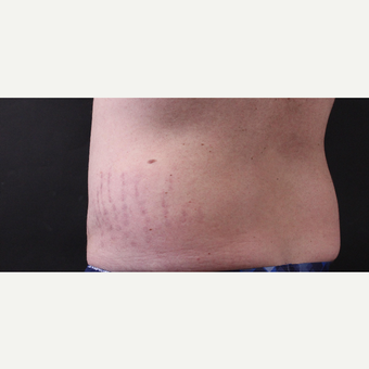 30 year old man treated with CoolSculpting before 3630349