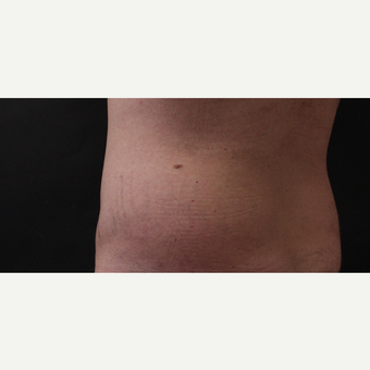 30 year old man treated with CoolSculpting after 3630349