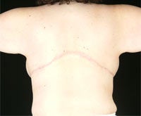 Body Contouring - Backlift after 1058660