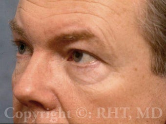 Eyelid surgery (Blepharoplasty)--upper and lower eyelids before 596332