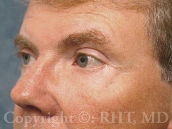 Eyelid surgery (Blepharoplasty)--upper and lower eyelids after 596332
