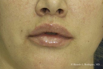 Lip Lift after 615879