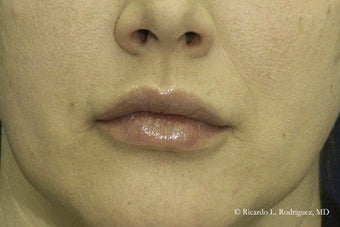 Lip Lift before 615879