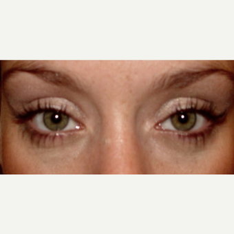 Genetic Eye Bags Can Distract from Gorgeous Eyes after 2767751