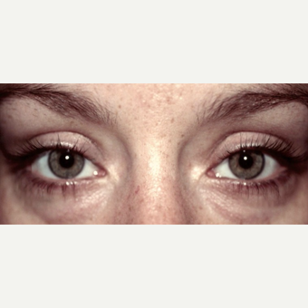 Genetic Eye Bags Can Distract from Gorgeous Eyes before 2767751