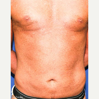 45-54 year old man treated with Male Breast Reduction after 3066101