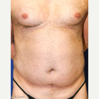 45-54 year old man treated with Male Breast Reduction before 3066101