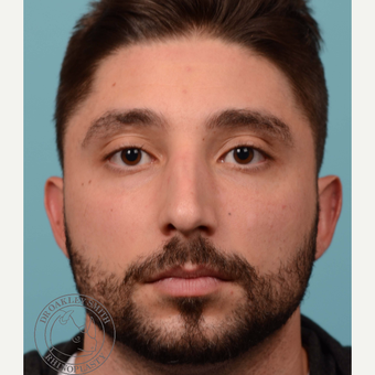 25-34 year old man treated with open Septoplasty/revision rhinoplasty before 3108870