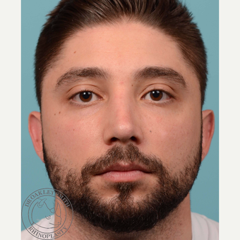 25-34 year old man treated with open Septoplasty/revision rhinoplasty after 3108870