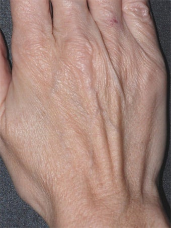 Aging Hands before 340590