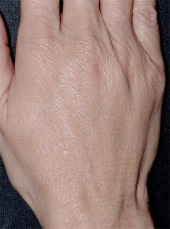 Aging Hands after 340590