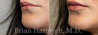 28 year-old female 1 week before and after lip injection with Restylane before 3441378